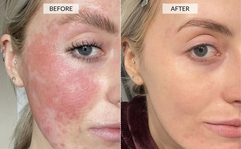 best red light therapy device for rosacea_1