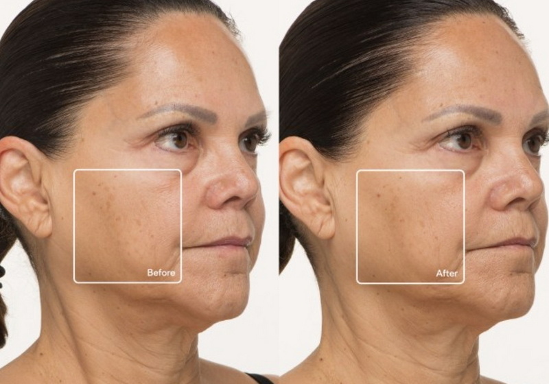is led face mask good for age spots_3_1