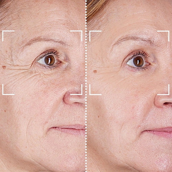 red led face mask before and after_2