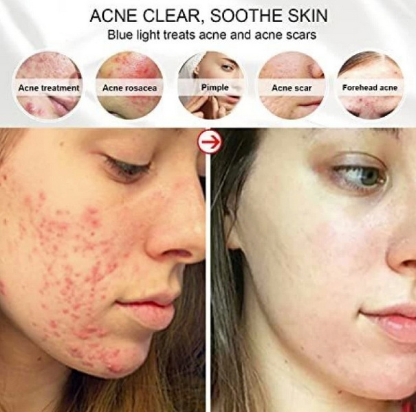 what color helps acne scars led light mask_2