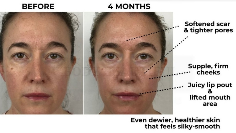 skinclinical reverse anti-aging red light therapy device vs nuface ele_3