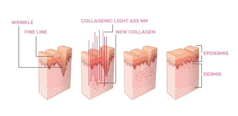 fda red light therapy device_1