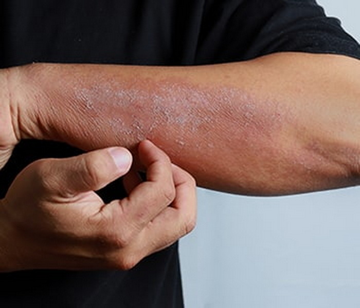 best red light therapy device for eczema_3