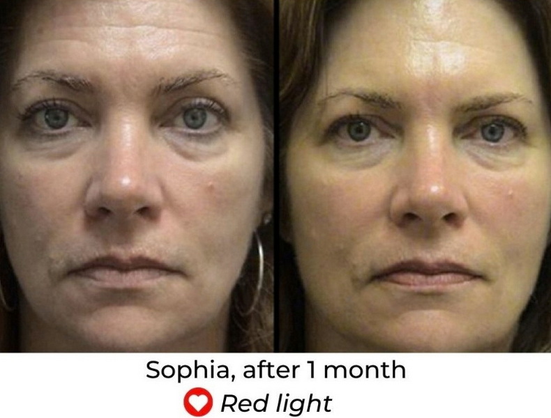is led face mask good for age spots_2_1