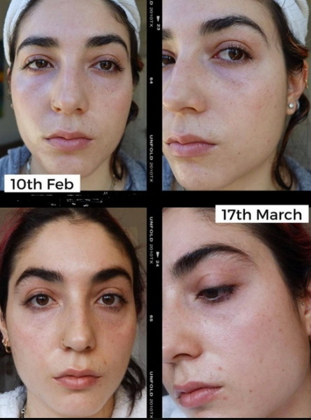 how long before you see results from led face mask_3