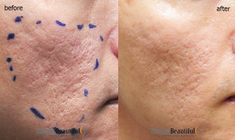 what color helps acne scars led light mask_1