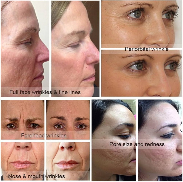 quasar md plus anti aging red light therapy device_2.jpg