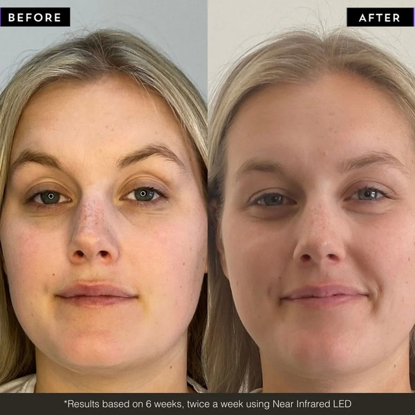 how long before you see results from led face mask_2