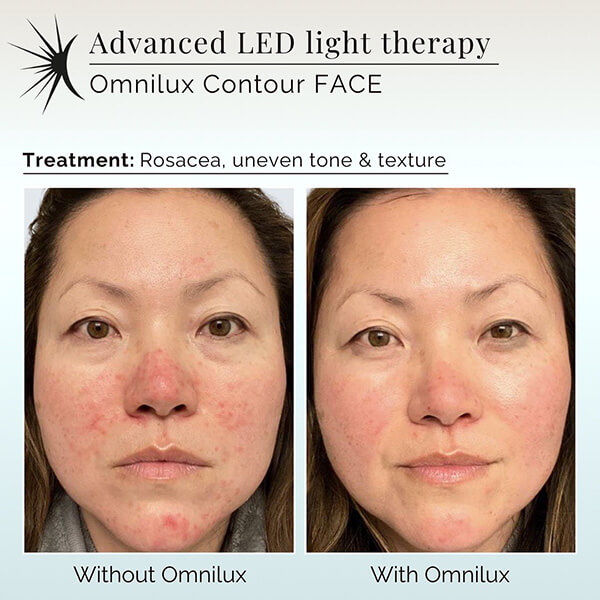 led face mask pigmentation_1