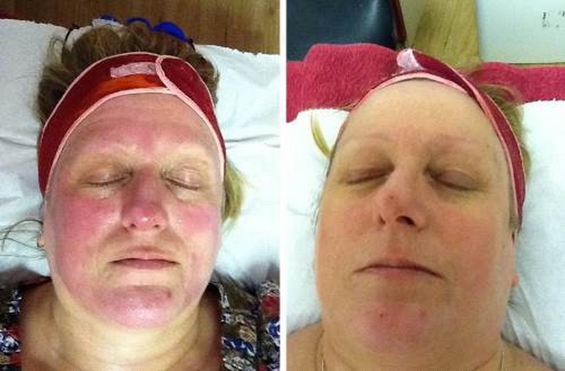 does an led face mask help with rosasea_1