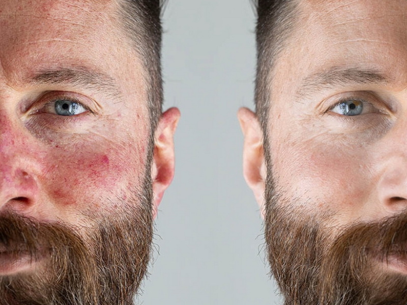 red light therapy device for rosacea_1