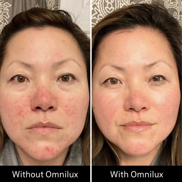 omnilux contour face red light therapy device_3