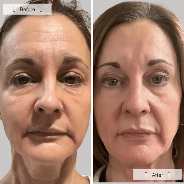 omnilux contour face red light therapy device_1