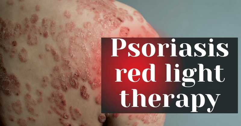 best red light therapy device for psoriasis_2