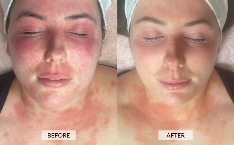 Red Light Therapy Effectiveness