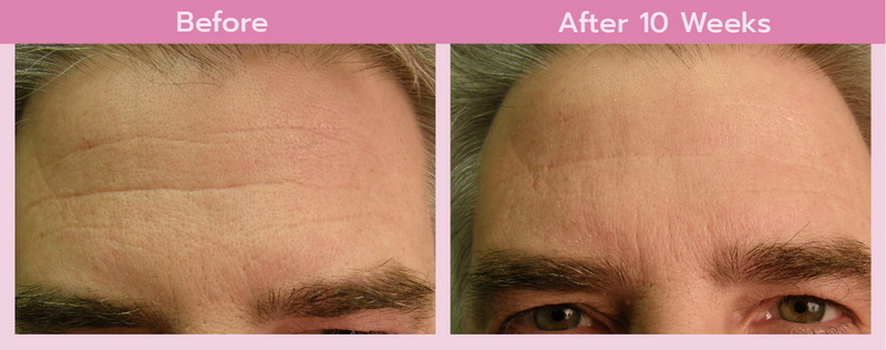 best red light therapy device for wrinkles_3