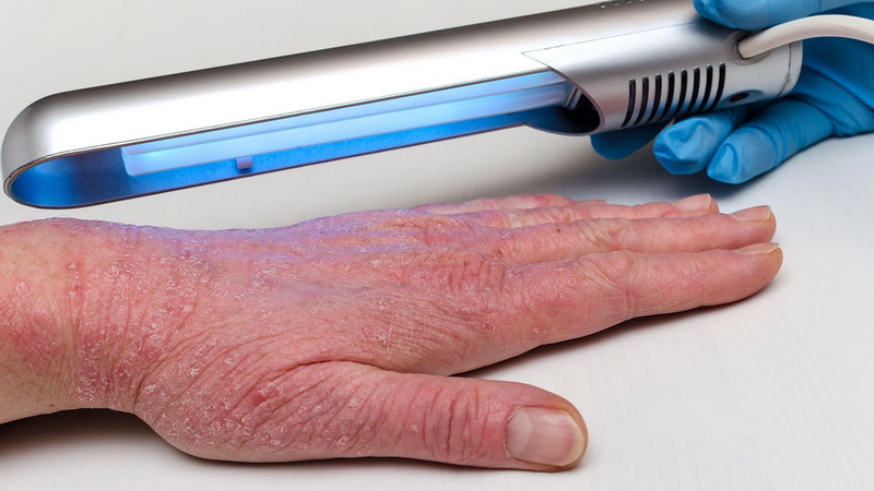 best red light therapy device for eczema_1